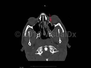 Imaging Studies image of Blow-out fracture of orbit - imageId=7888574. Click to open in gallery.  caption: '<span>Axial CT sequence demonstrates  a depressed fracture of the inferior wall of the orbit. On soft tissue  windows there is a small left maxillary hemosinus.</span>'