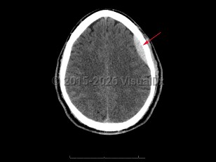 Epidural intracranial hematoma