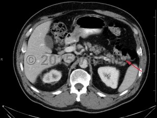 Imaging Studies image of Colonic polyps - imageId=7904556. Click to open in gallery.  caption: '<span>Axial CT image demonstrates a  soft tissue density at the splenic flexure. Subsequent colonoscopy  findings were consistent with colonic polyp.</span>'