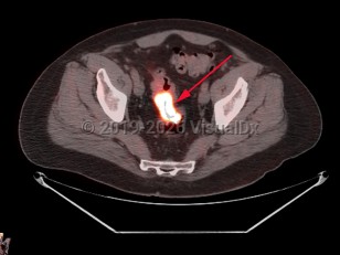 Rectal carcinoma