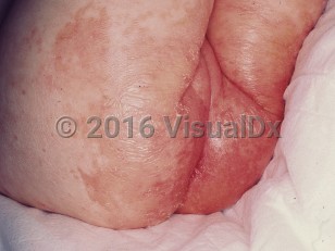 Clinical image of Propionic acidemia - imageId=799487. Click to open in gallery.  caption: 'Widespread scaly and desquamating erythematous papules and plaques in the diaper area.'