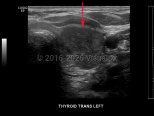 Imaging Studies image of Thyroid cancer - imageId=8340636. Click to open in gallery.  caption: '<span>Grayscale transverse ultrasound image of the thyroid gland demonstrates a large, hypoechoic  mass in the left lobe. Biopsy proven medullary  thyroid cancer.</span>'