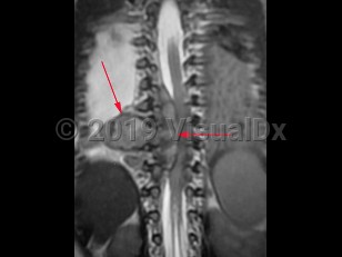 Imaging Studies image of Neuroblastoma - imageId=8343616. Click to open in gallery.  caption: '<span>T2 sagittal MRI of thorax showing large neuroblastoma along the mid thoracic spine.</span>'