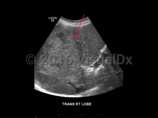 Imaging Studies image of Hepatocellular carcinoma - imageId=8358911. Click to open in gallery.  caption: '<span>Grayscale ultrasound image of the liver demonstrating a heterogeneously hyperechoic mass in the right lobe of the liver. Pathology proven hepatocellular carcinoma.</span>'