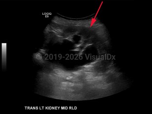 Hydronephrosis