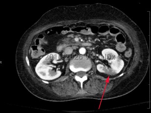 Renal infarction