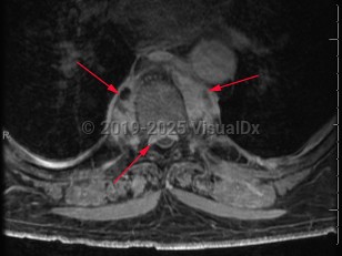 Imaging Studies image of Paraspinal abscess - imageId=8364015. Click to open in gallery.  caption: '<span>Axial T1FS post-contrast MRI  sequence demonstrates discitis osteomyelitis of the thoracic spine at  T7-T8 with an associated paravertebral abscess. Note the extent of  surrounding inflammatory changes in the paravertebral soft tissues - the  non-enhancing portion corresponded to a fluid collection.</span>'