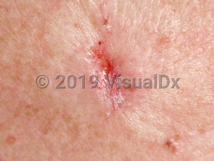 Clinical image of Infiltrating basal cell carcinoma - imageId=88519. Click to open in gallery.  caption: 'A close-up of a shiny, whitish-pink plaque with a central depressed erosion and scale.'