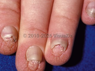 Clinical image of Hidrotic ectodermal dysplasia - imageId=96732. Click to open in gallery.  caption: 'Micronychia and a rugose appearance of the distal fingers.'